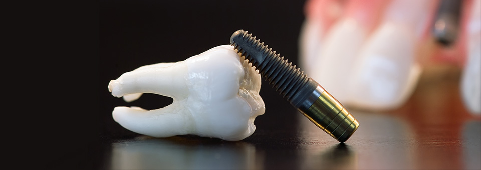 Service de prothèse dentaire sur implant à Québec | Denturologiste Alain Hamel